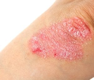 xtrac psoriasis