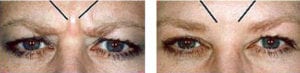 Botox before and after