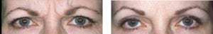 Botox before and after