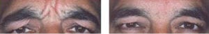 Botox before and after