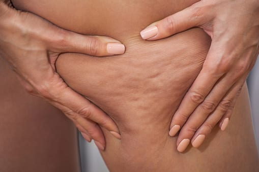 Girl shows pushing the skin of the legs cellulite.