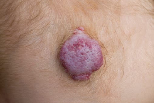 hemangioma