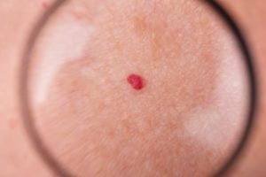 Hemangiomas Removal Mountain View, CA