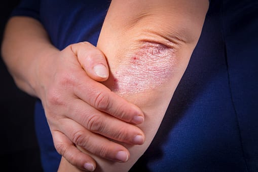 Psoriasis Care in Mountain View
