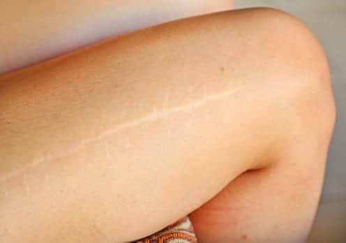 Scar on female leg