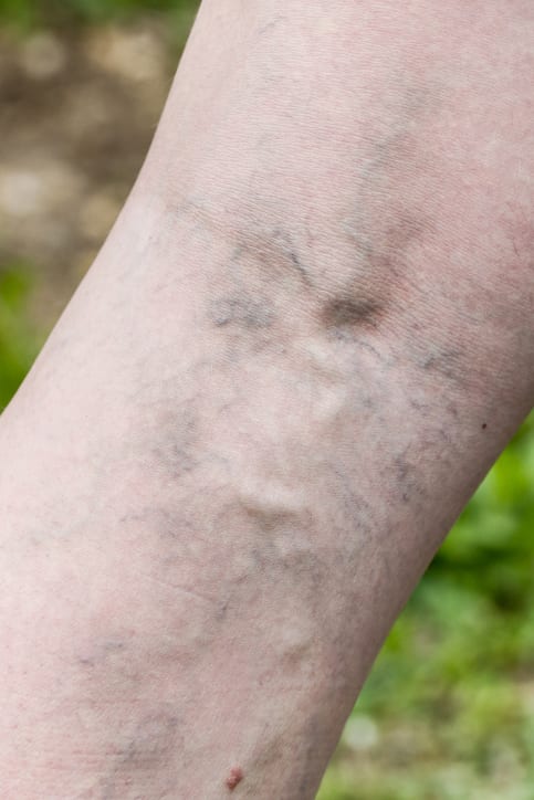 Woman with painful varicose and spider veins on her legs. Vascular disease, varicose veins problems, painful unaesthetic medical condition concept.