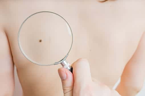 skin-cancer-2