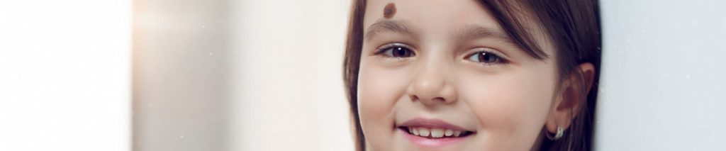 Birthmark