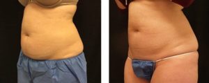 coolsculpting gr1 1