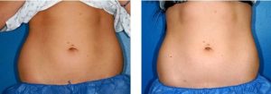 coolsculpting gr1 10