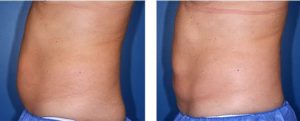 coolsculpting gr1 11