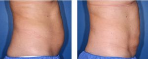 coolsculpting gr1 12