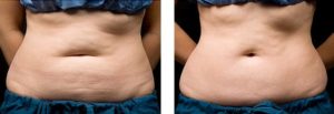 coolsculpting gr1 13