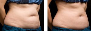 coolsculpting gr1 14