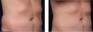 coolsculpting gr1 15