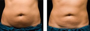 coolsculpting gr1 17