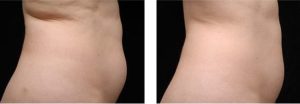 coolsculpting gr1 18