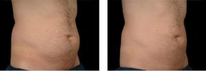 coolsculpting gr1 19