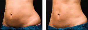 coolsculpting gr1 20