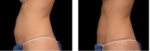 coolsculpting gr1 21