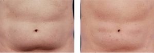 coolsculpting gr1 22