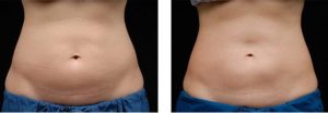 coolsculpting gr1 23