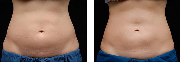 Thank you to our client who let us video her having a Coolmini treatment to  her mons pubis. Video 1: Coolmini going on. Coolsculpting is a fabulous