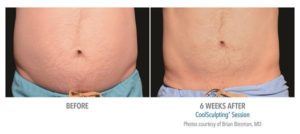 coolsculpting gr1 4 1