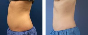 coolsculpting gr1 5