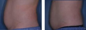 coolsculpting gr1 7