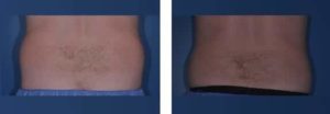 coolsculpting gr1 8