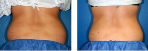 coolsculpting gr1 9