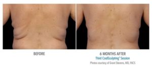 coolsculpting gr2 1