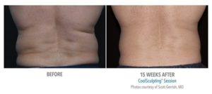 coolsculpting gr2 2