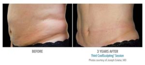 coolsculpting gr2 3