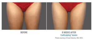 coolsculpting gr3 1