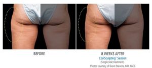 coolsculpting gr3 2