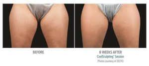 coolsculpting gr3 3