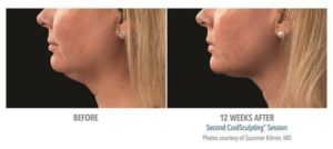 coolsculpting gr4 3