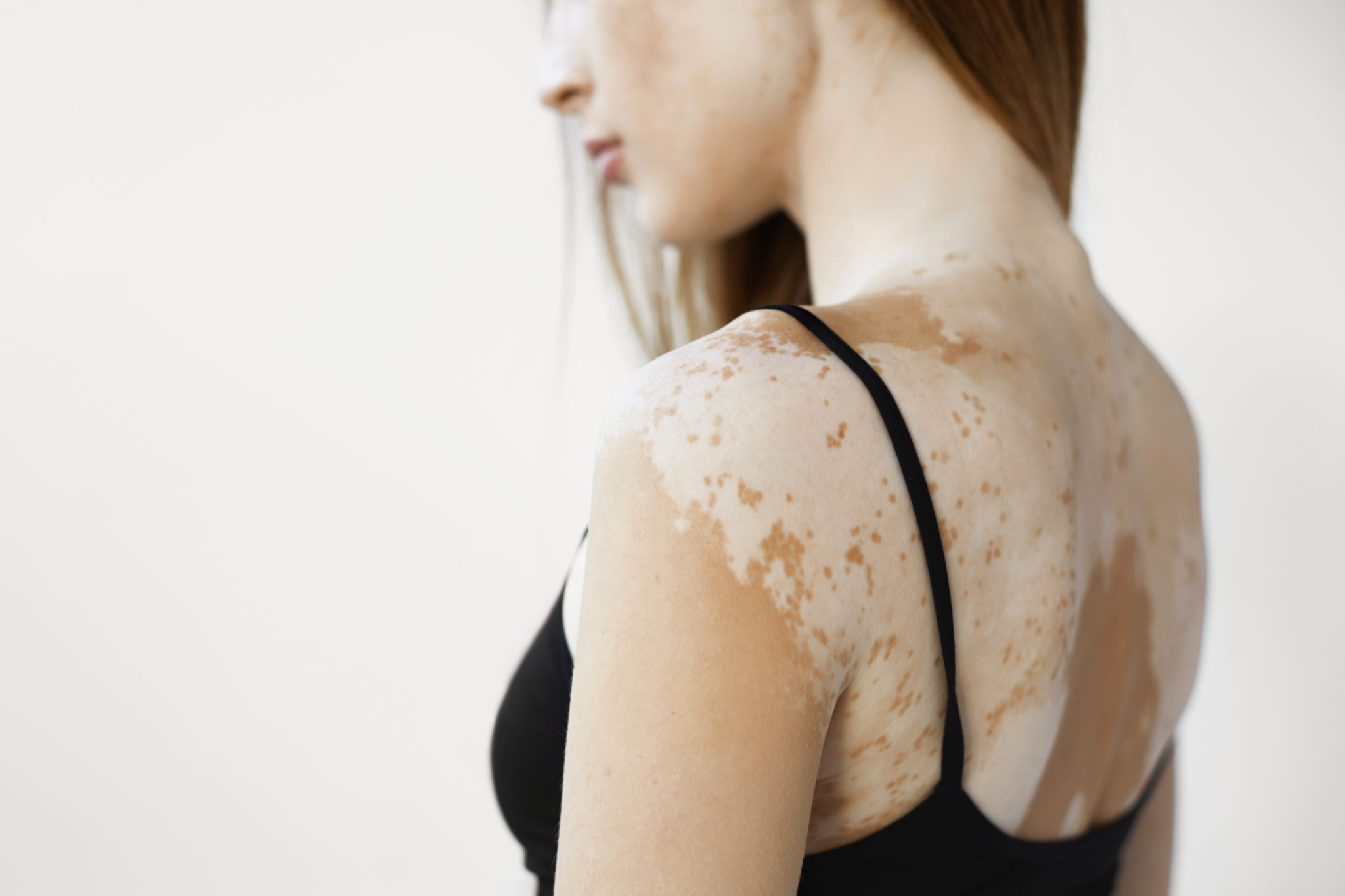 Cropped back view of beautiful young European woman with vitiligo which causes loss of melanin posing indoors. Slender slim female model in black tank top suffering from vitiligo disorder