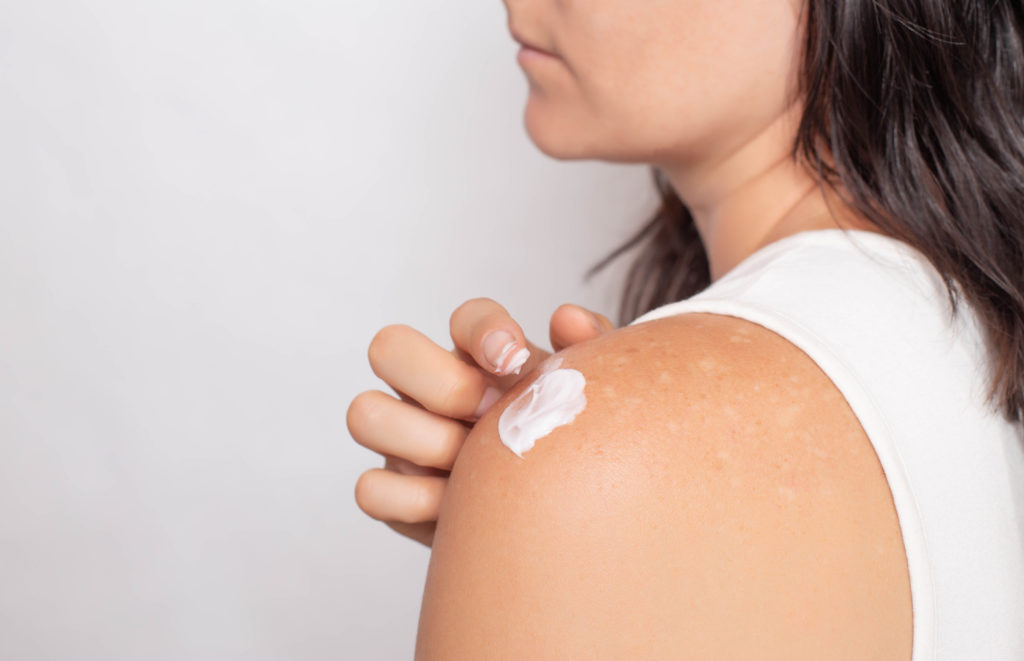The girl smears problem skin with pigmented spots on the shoulder with a healing cream, treatment of vitiligo with the help of a healing ointment.