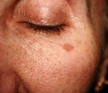 brown spots treatment mountain view