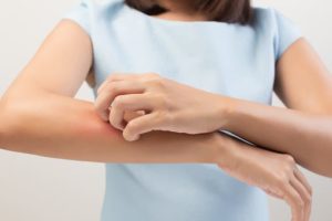 eczema eczema