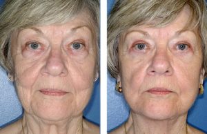 face and neck lift2