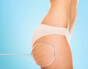 Cellulite Treatment