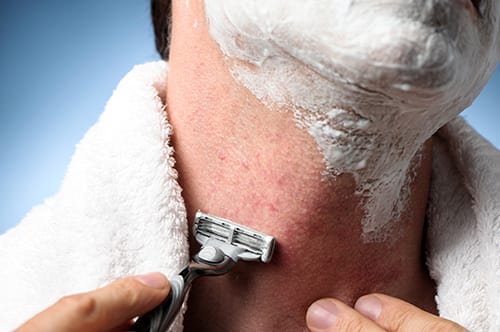 shaving folliculitis shaving folliculitis