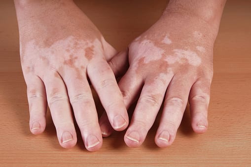 Vitiligo: like snow - It can melt away - The Vit Pro (A Vitiligo Blog)