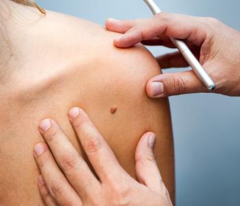 warts removal near mountain view ca