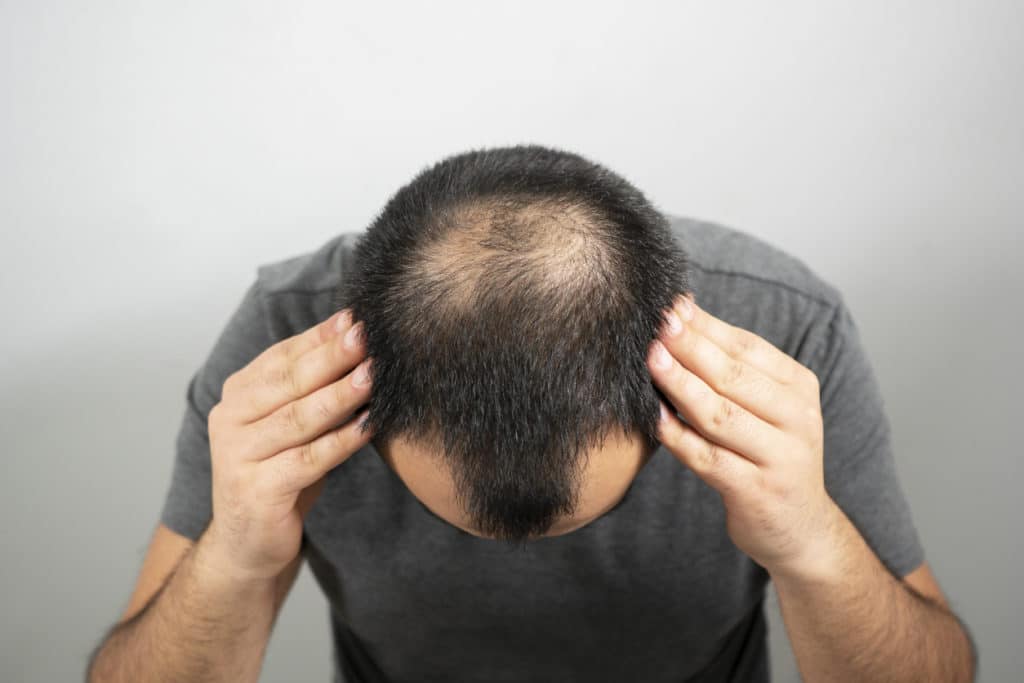 Alopecea