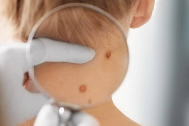 Skin Cancer Treatment in Mountain View